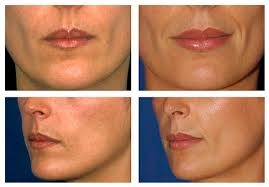 Clínicas de Estética para Preenchimento Facial no Campo Belo - Clínica de Estética para Flacidez